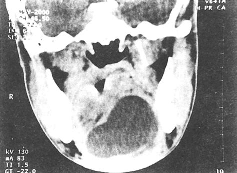 Image result for Exploding Mouth Cyst