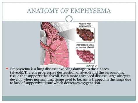 Image result for Emphysema Example