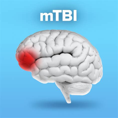 Medicortex Finland Oyj on LinkedIn: Concussion – a diagnostic challenge ...