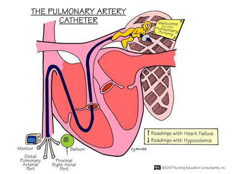The Pulmonary Arterial Catheter | Medical surgical nursing, Surgical ...