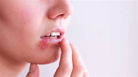 Differences Between HSV-1 and HSV-2: Oral and Genital Herpes | Allure