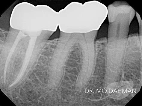 Gold Crown X Ray at Pamala Steven blog