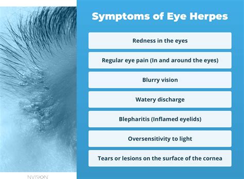 Eye Herpes: Causes, Treatment & What Not to Do – NVISION