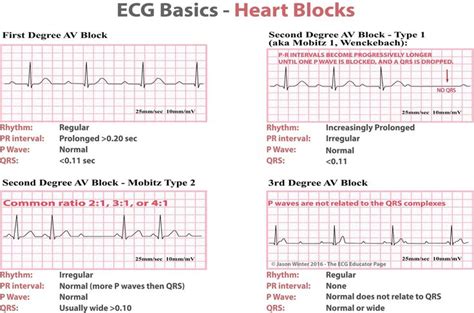 Printable Ekg Practice Strips With Answers