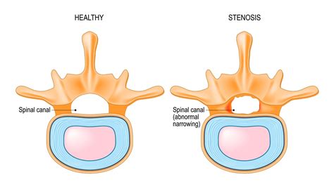 Can Spinal Stenosis Kill You