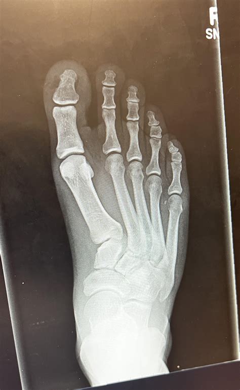 X Ray Of Foot Foot Radiograph (an Approach) | Radiology Reference