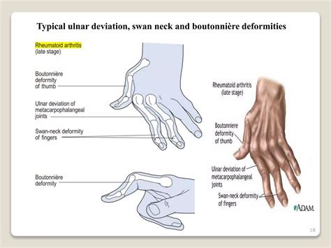 RHEUMATOID ARTHRITIS.pptx