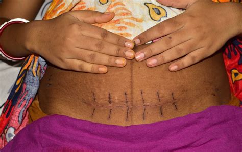Cesarean Section Incision Types