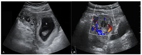9 Week Ectopic Pregnancy Ultrasound