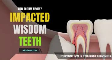 Image result for How to Remove Teeth Video