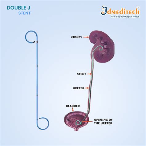 Ureteric Jj Stent