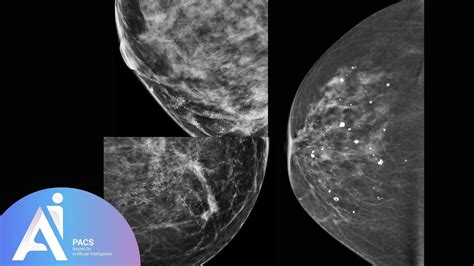 Micro Calcification Of The Breast