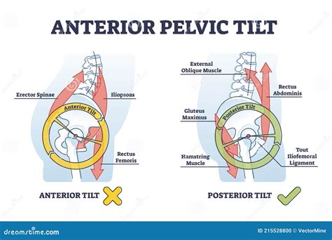 Anterior Pelvic Tilt Model Compared with Posterior in Labeled Outline Diagram Stock Vector ...