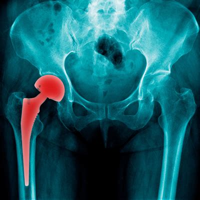 Hip Replacement Surgery in Guntur | Best Back Pain Hospital in Guntur ...
