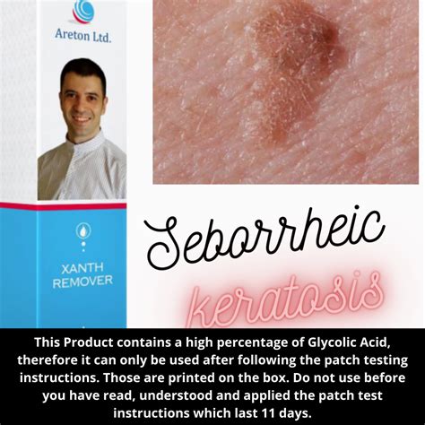 Seborrheic Keratosis Face Removal