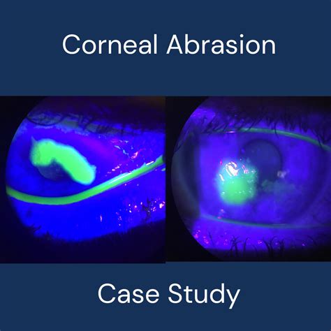 How to treat corneal abrasion/scratch – Optiplex Children's Eyecare