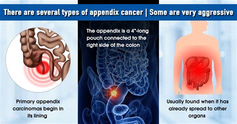 Image result for Appendix Cancer Symptoms