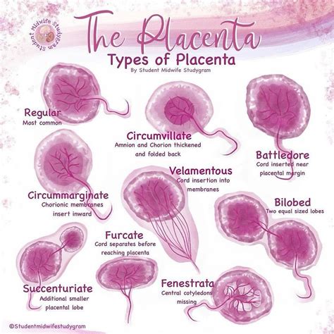 Kristin Eapen CD(DONA), LCCE | . . . There are many different types of placentas! The second ...