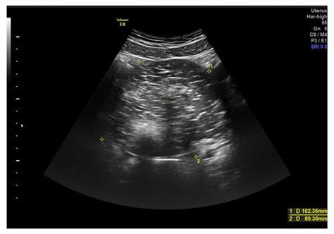 Ultrasound Features and Ultrasound Scores in the Differentiation ...