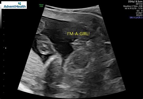 Skeptical it's a girl (20 week ultrasound) | BabyCenter