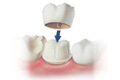 Dental Crowns, Bridges & Caps Implant in Aurangabad | 100% Fabrication