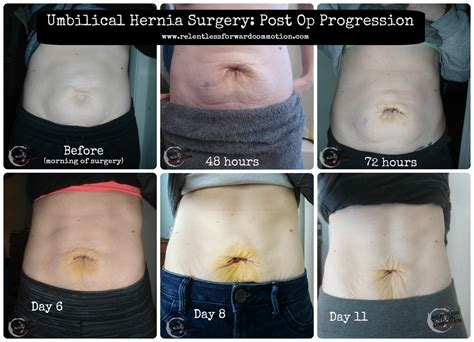 What to Expect During Umbilical Hernia Surgery Recovery - RELENTLESS ...
