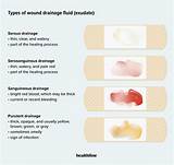 Wound Discharge Types