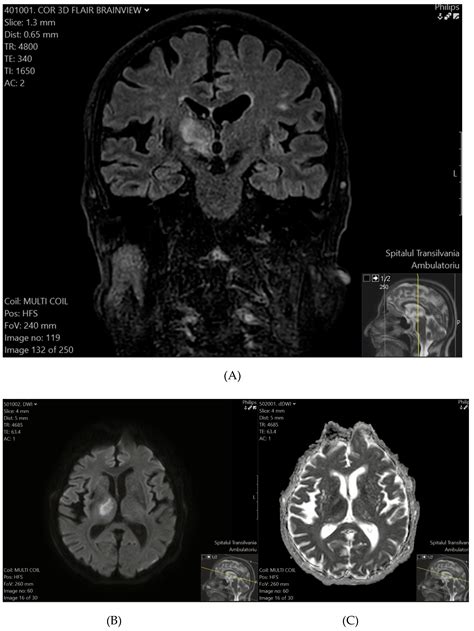 Assessing Acute DWI Lesions in Clinically Diagnosed TIA: Insights from ...