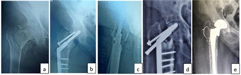 Fixation stability scoring in inter-trochanteric femur fractures ...