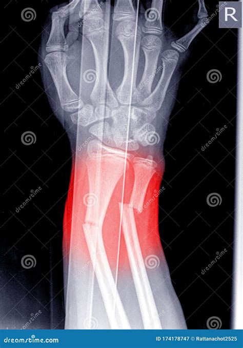 X Ray Of Human Hand With Broken Wrist Fracture Of Radius