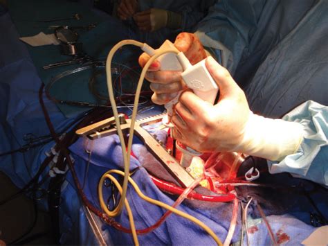 Defibrillation | Anesthesia Key