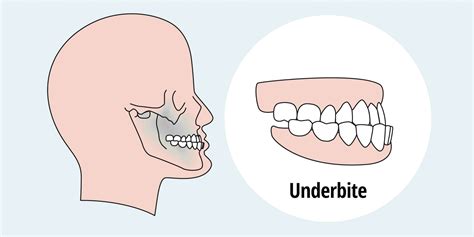 Underbite Teeth Cleaning at Thomas Gabaldon blog
