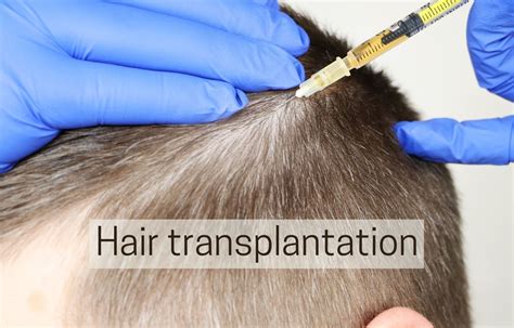 Hair Transplantation facility told to refund after denying surgery to ...