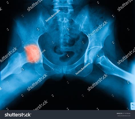 Xray Image Both Hip Frogleg Position Stock Photo (Edit Now) 311678546