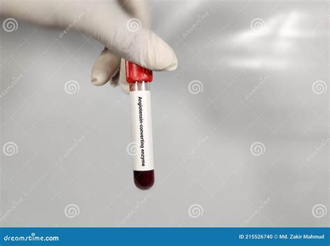 Test Tube with Blood Sample for Angiotensin-converting Enzyme ACE Test ...