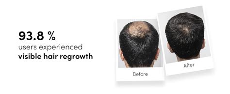 Man Matters Minoxidil 5% with Finasteride Solution Serum I Prevent Hair ...