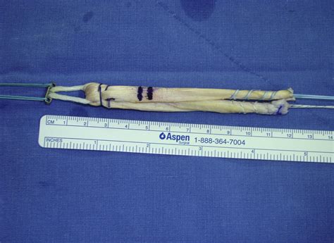 Single-Bundle Anterior Cruciate Ligament Reconstruction in Active Young ...