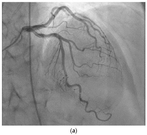 Rare Clinical Manifestation of Vasculitis