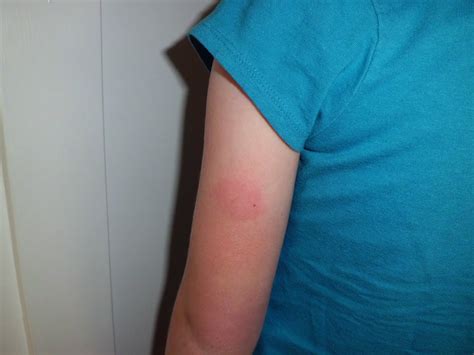 Reactions to allergy shots