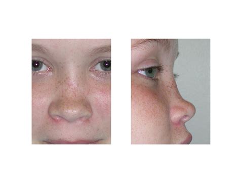 Case Study: Rib Grafting for the Saddle Nose Deformity - Explore Plastic Surgery