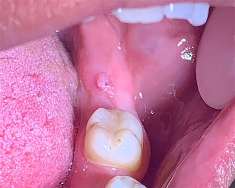 Peripheral ameloblastoma underlying squamous cell papilloma following a third molar extraction ...