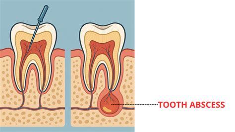 Abscess under Root Canal: Don't Ignore It!