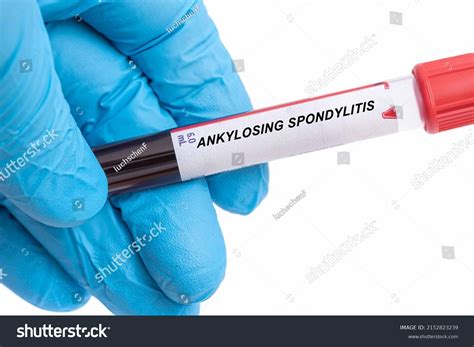Ankylosing Spondylitis Ankylosing Spondylitis Disease Blood Stock Photo ...