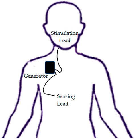 Hypoglossal Nerve Stimulator Placement for Pediatric Trisomy 21 Patients with Refractory ...