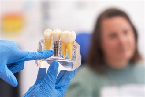 Dental Implant Overdenture Clinical Process - STOMADENT