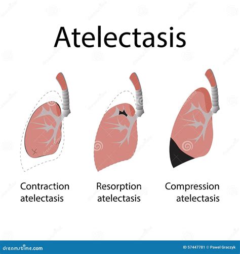 Pneumothorax Vs Atelectasis