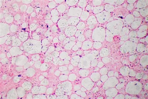Liposarcoma vs Lipoma - Cancer Therapy Advisor
