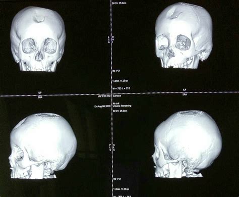 颅骨骨折x线照片，侧位照片摄影图片_ID:140717572-Veer图库