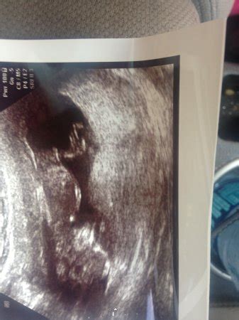 Is nub theory completely accurate at 11 weeks 5 days? | BabyCenter