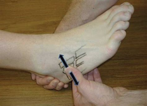 Severe Pain In Cuboid Bone at Harold Case blog